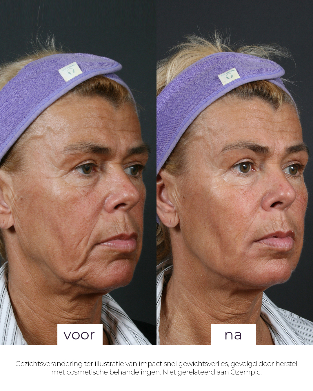 Ozempic gezicht simulatie Elzen Kliniek