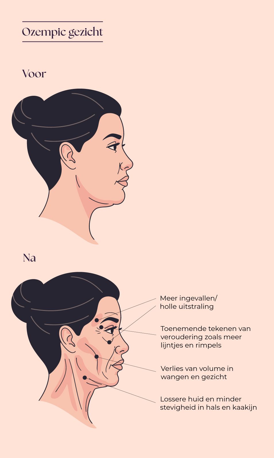 Ozempic Face Voor en na De Elzen Kliniek
