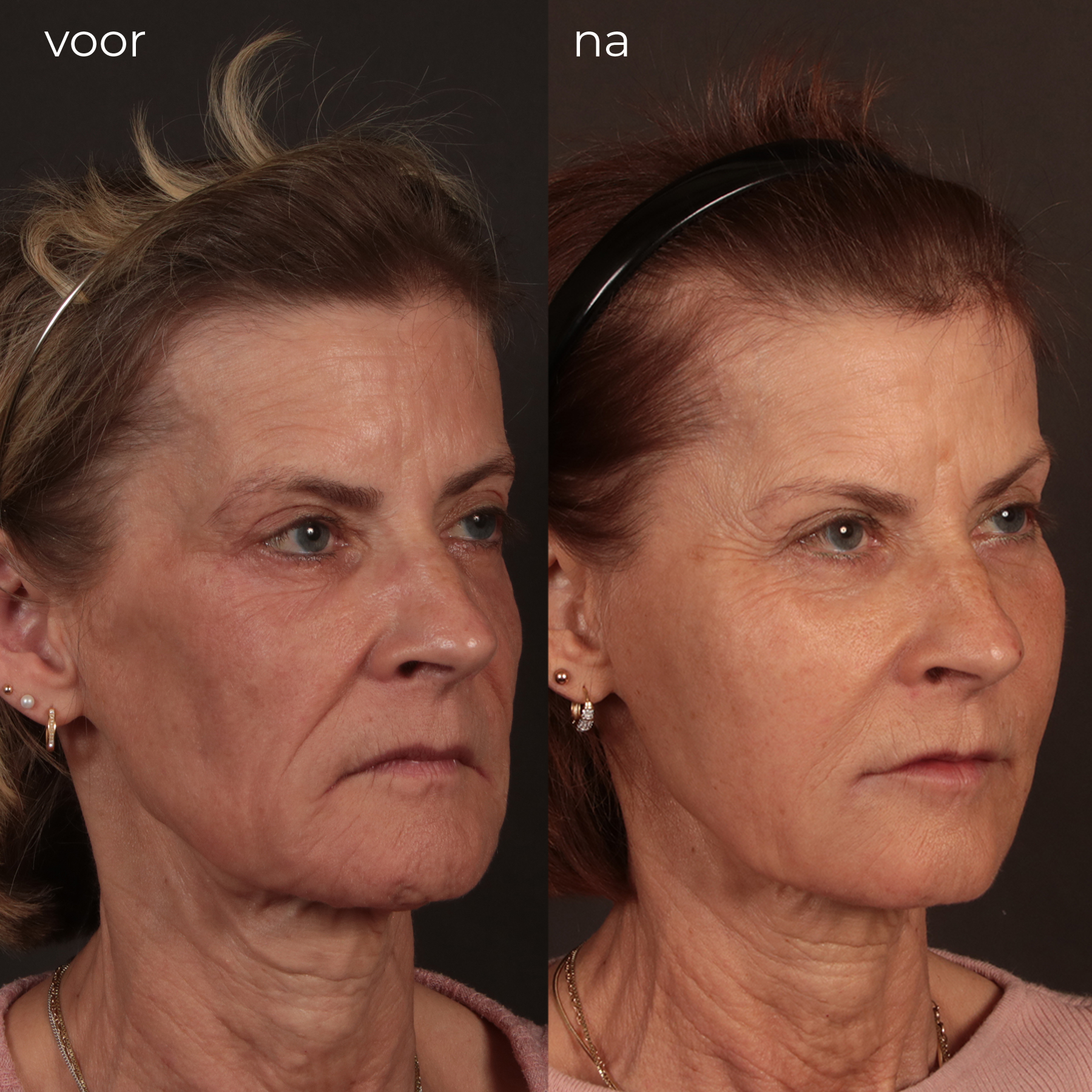 Voor en na beelden behandeling Liquid Facelift Elzen Kliniek