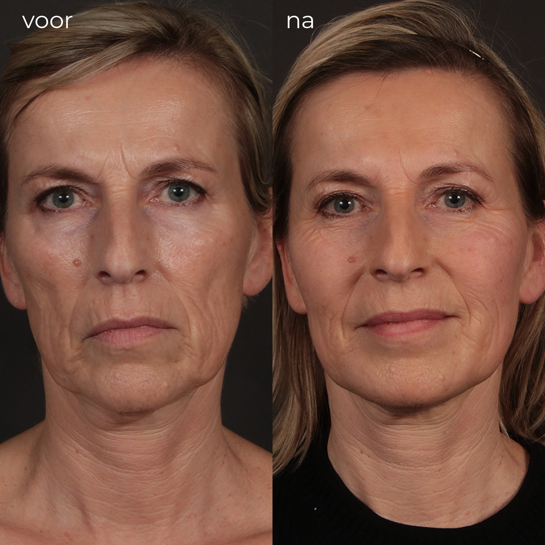 Voorna-Ozempic-face-Elzen-Kliniek